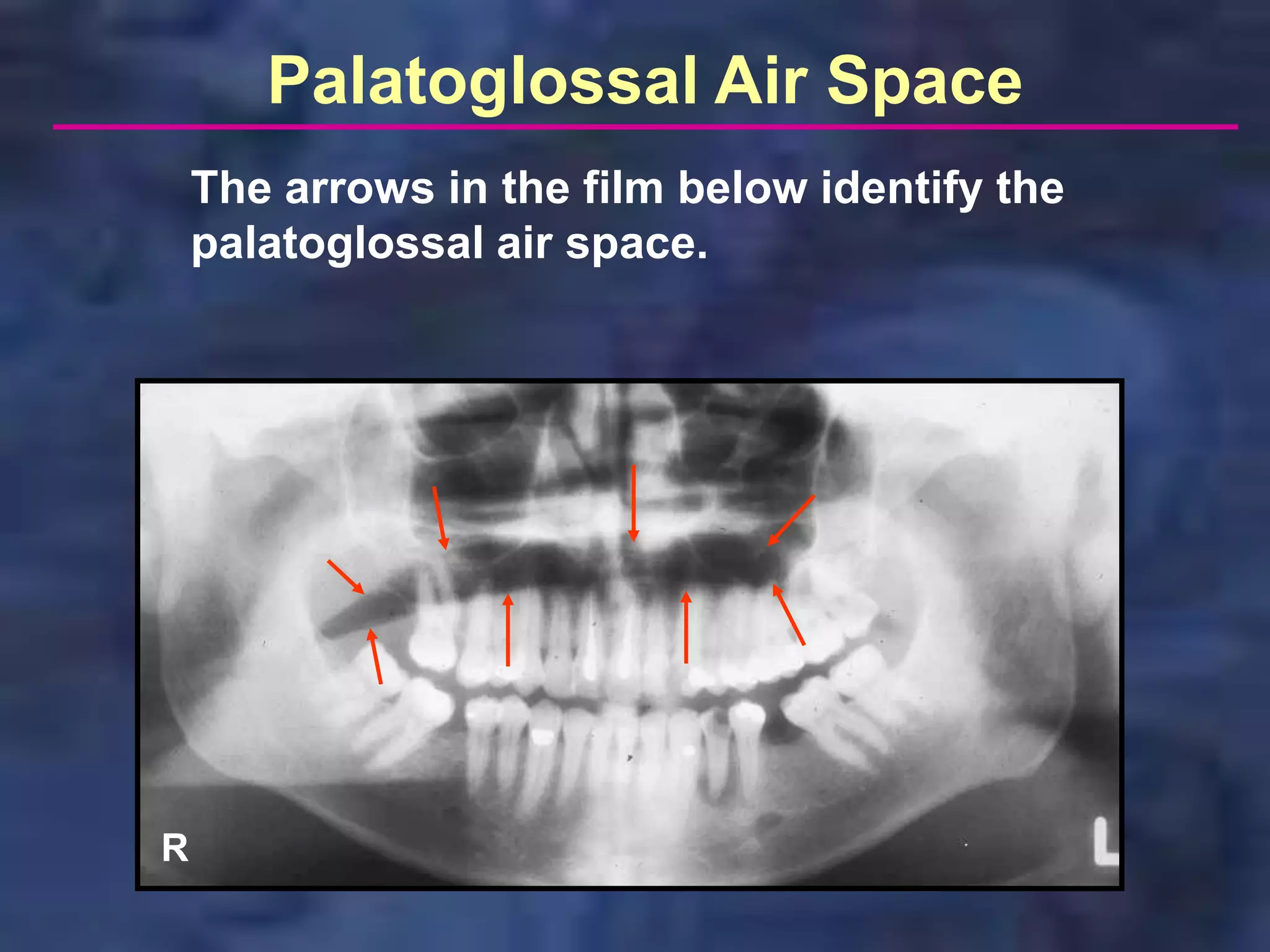Palatoglossal Air Space
    The arrows in the film below identify the
    palatoglossal air space.




R
 