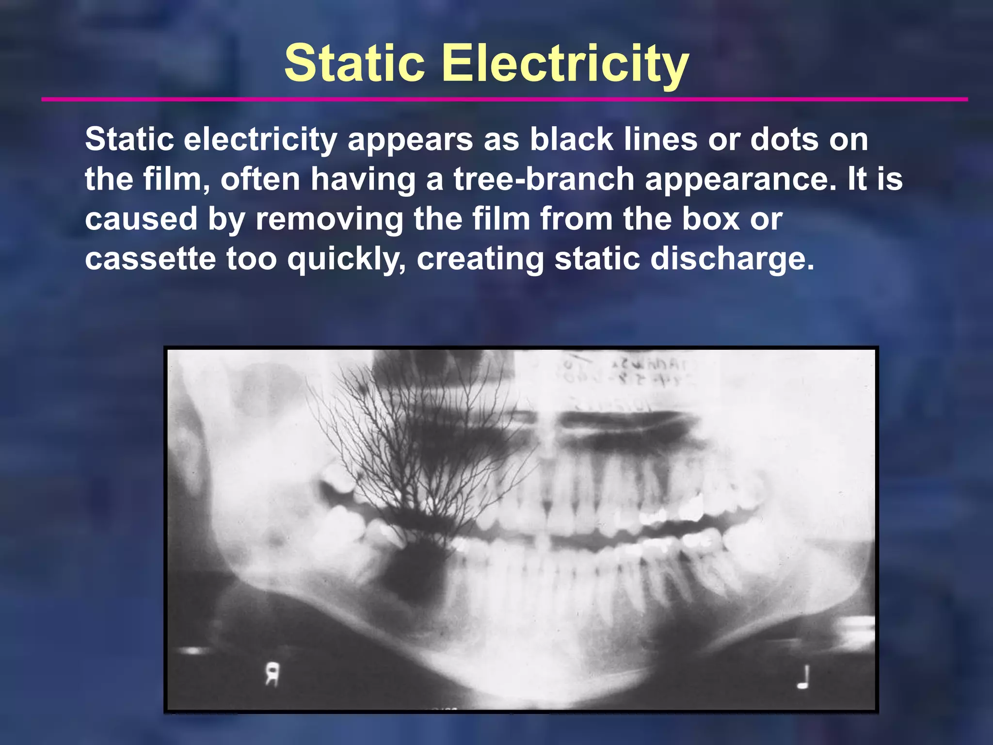 Static Electricity
Static electricity appears as black lines or dots on
the film, often having a tree-branch appearance. It is
caused by removing the film from the box or
cassette too quickly, creating static discharge.
 