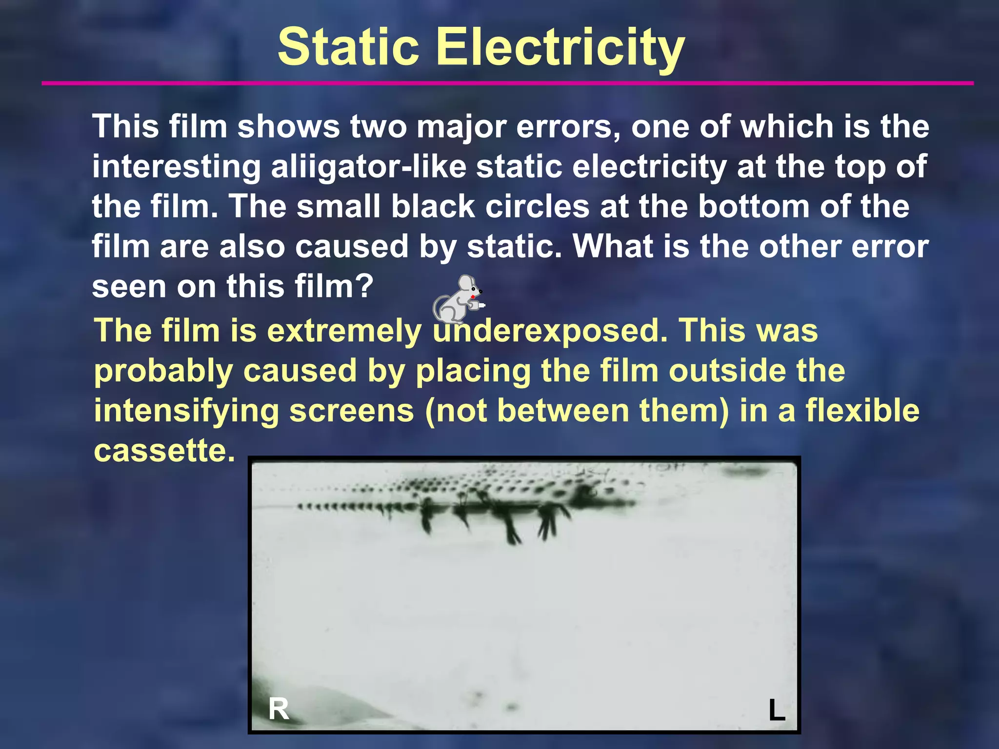Static Electricity
This film shows two major errors, one of which is the
interesting aliigator-like static electricity at the top of
the film. The small black circles at the bottom of the
film are also caused by static. What is the other error
seen on this film?
The film is extremely underexposed. This was
probably caused by placing the film outside the
intensifying screens (not between them) in a flexible
cassette.




            R                                  L
 