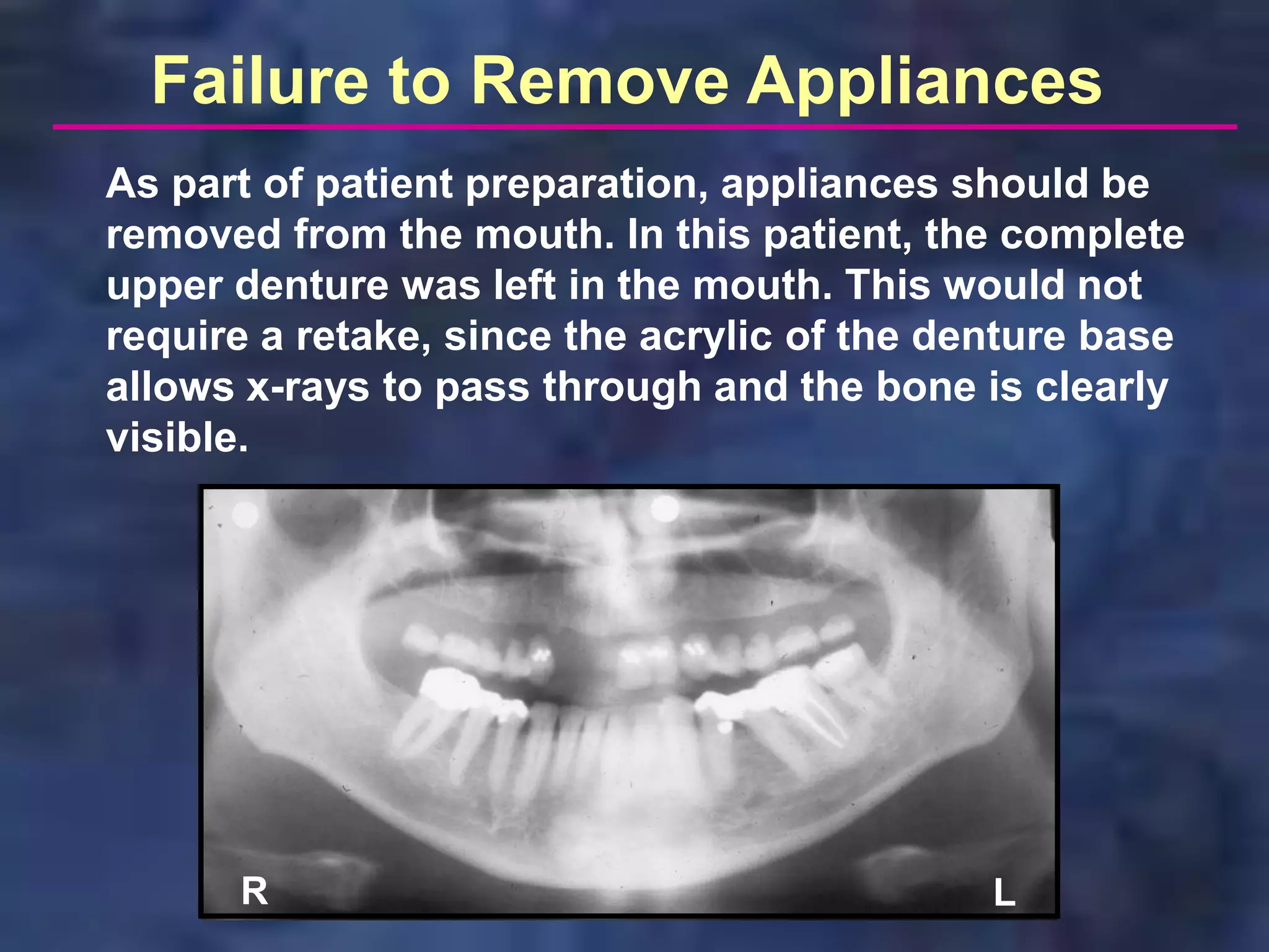 Failure to Remove Appliances
As part of patient preparation, appliances should be
removed from the mouth. In this patient, the complete
upper denture was left in the mouth. This would not
require a retake, since the acrylic of the denture base
allows x-rays to pass through and the bone is clearly
visible.




      R                                      L
 