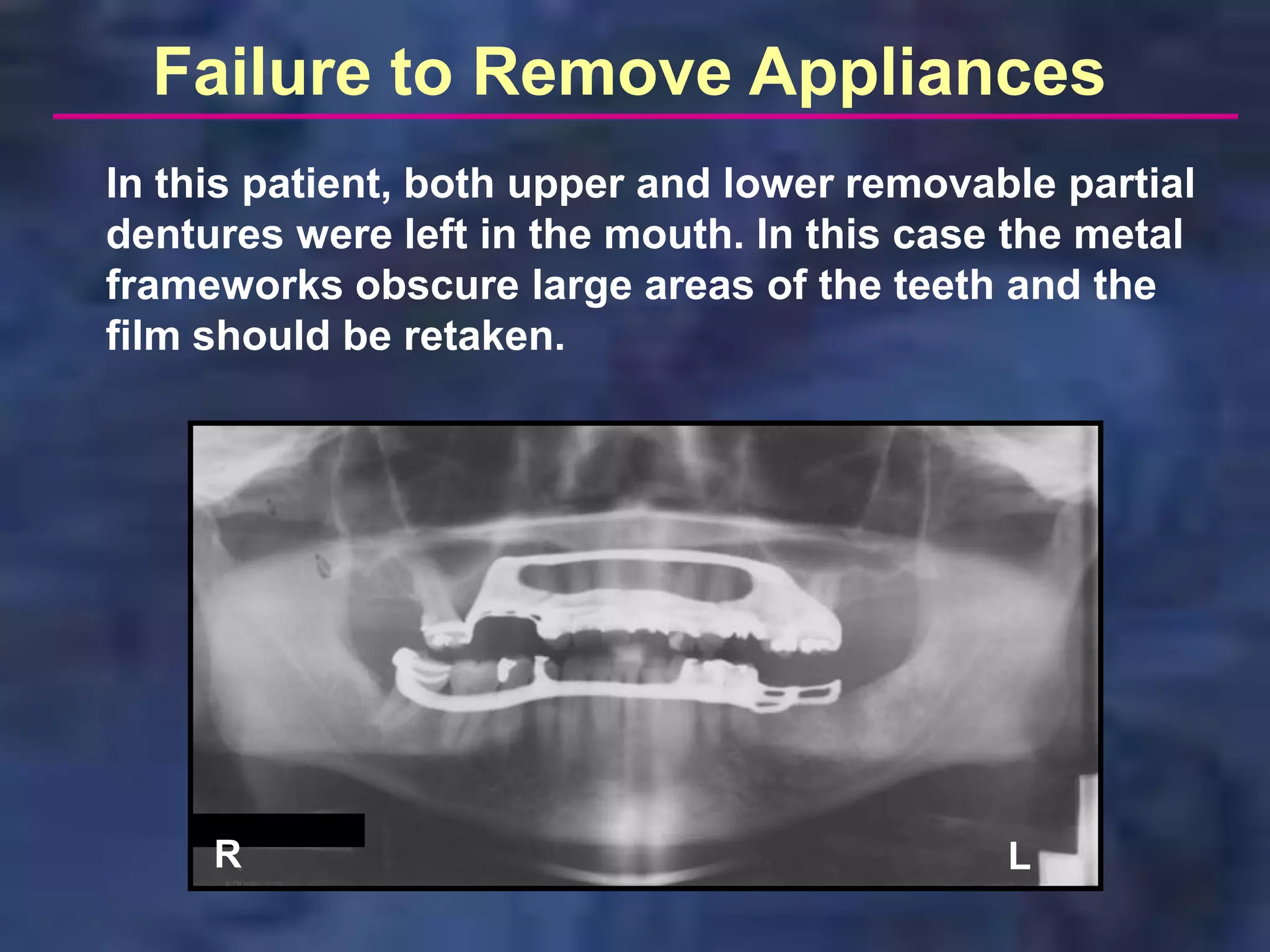 Failure to Remove Appliances
In this patient, both upper and lower removable partial
dentures were left in the mouth. In this case the metal
frameworks obscure large areas of the teeth and the
film should be retaken.




     R                                       L
 