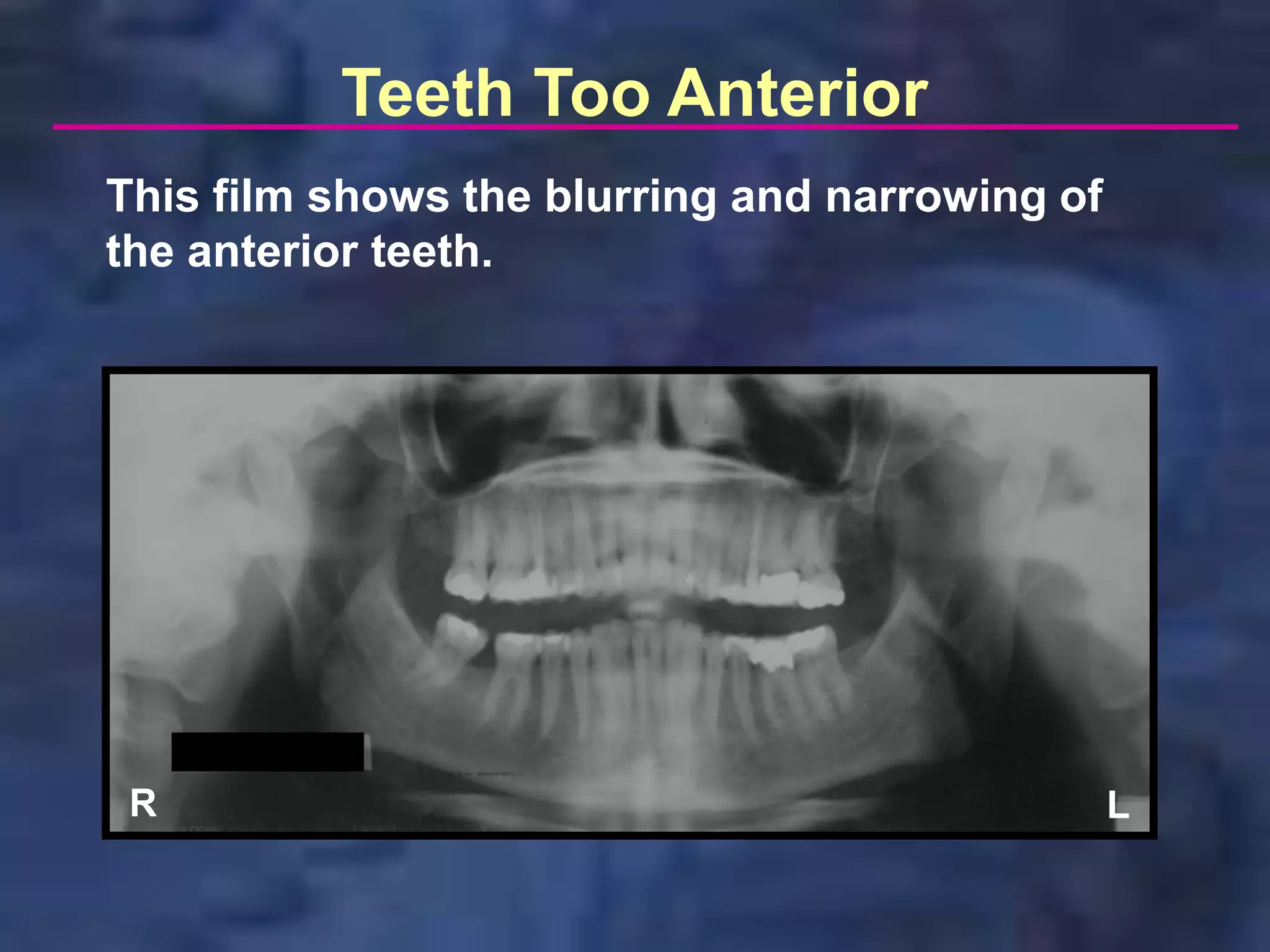 Teeth Too Anterior
This film shows the blurring and narrowing of
the anterior teeth.




 R                                              L
 