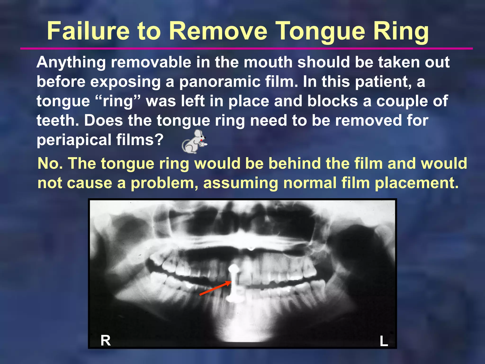 Failure to Remove Tongue Ring
Anything removable in the mouth should be taken out
before exposing a panoramic film. In this patient, a
tongue “ring” was left in place and blocks a couple of
teeth. Does the tongue ring need to be removed for
periapical films?
No. The tongue ring would be behind the film and would
not cause a problem, assuming normal film placement.




       R                                  L
 