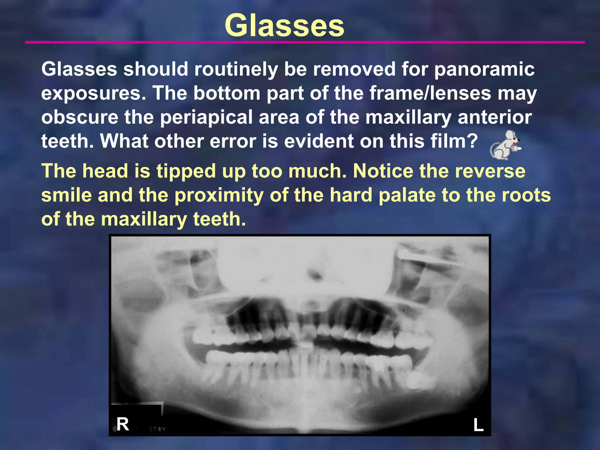 Glasses
Glasses should routinely be removed for panoramic
exposures. The bottom part of the frame/lenses may
obscure the periapical area of the maxillary anterior
teeth. What other error is evident on this film?
The head is tipped up too much. Notice the reverse
smile and the proximity of the hard palate to the roots
of the maxillary teeth.




        R                                     L
 