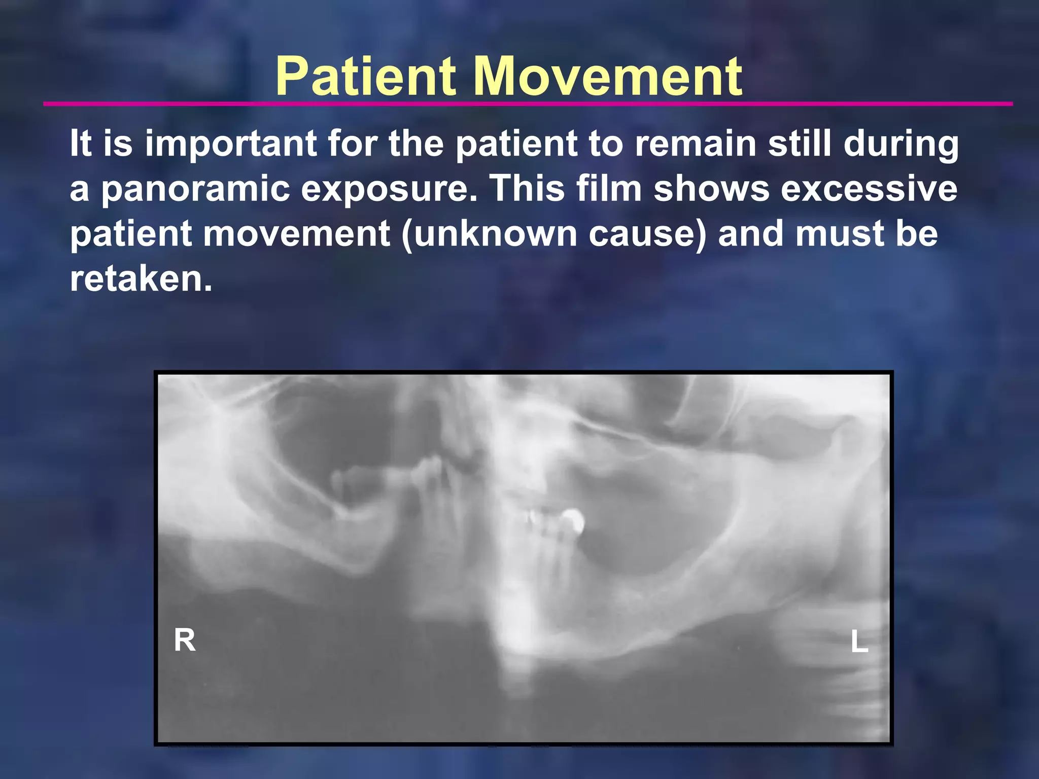 Patient Movement
It is important for the patient to remain still during
a panoramic exposure. This film shows excessive
patient movement (unknown cause) and must be
retaken.




      R                                        L
 