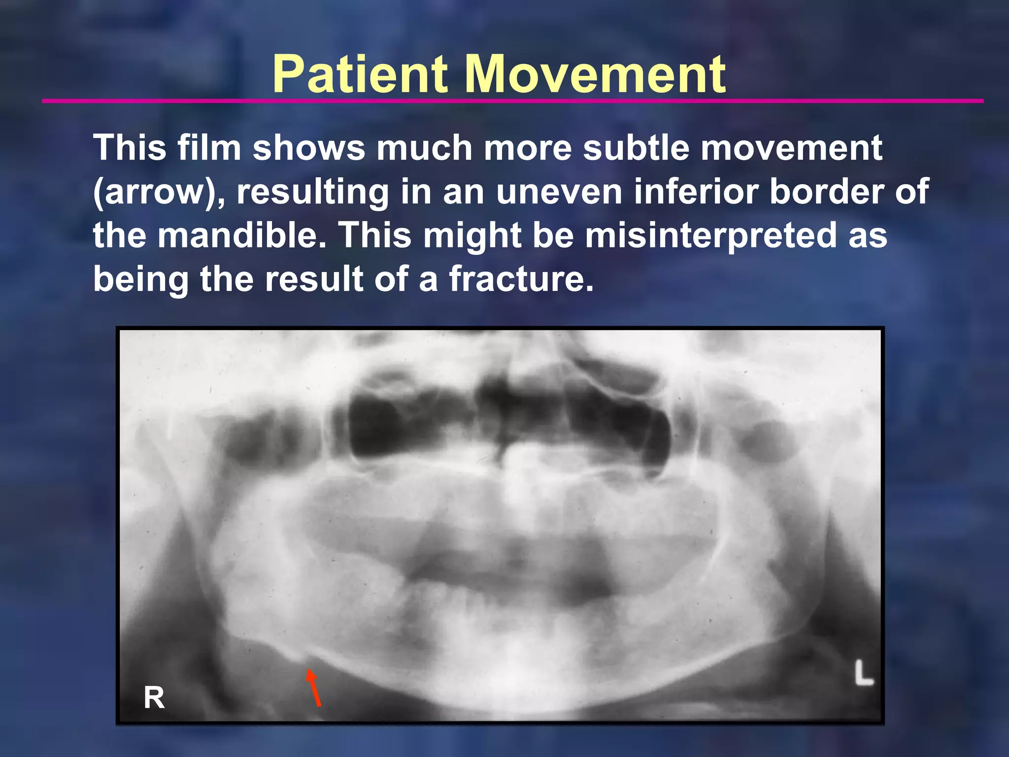 Patient Movement
This film shows much more subtle movement
(arrow), resulting in an uneven inferior border of
the mandible. This might be misinterpreted as
being the result of a fracture.




   R
 