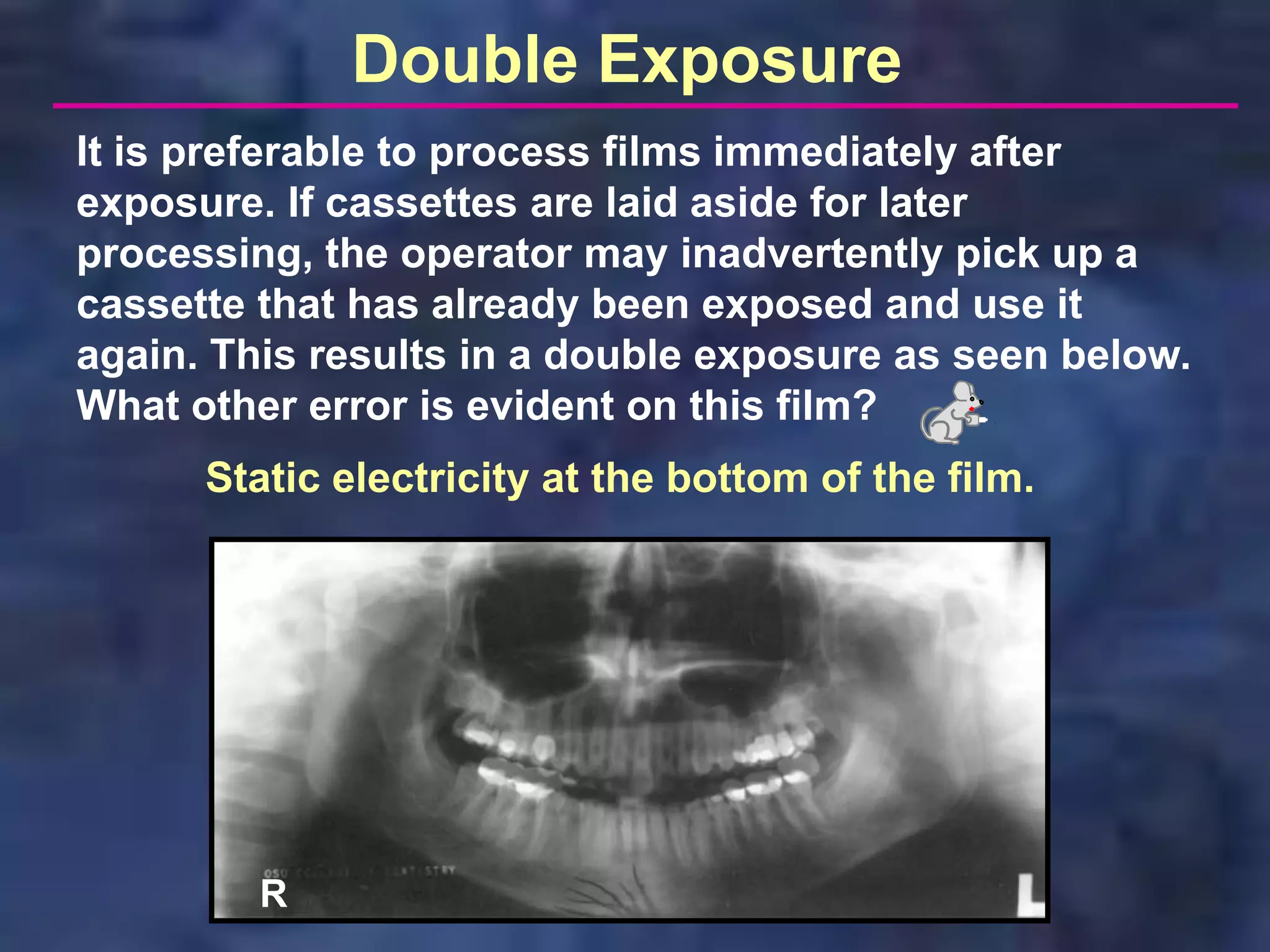 Double Exposure
It is preferable to process films immediately after
exposure. If cassettes are laid aside for later
processing, the operator may inadvertently pick up a
cassette that has already been exposed and use it
again. This results in a double exposure as seen below.
What other error is evident on this film?
      Static electricity at the bottom of the film.




         R
 