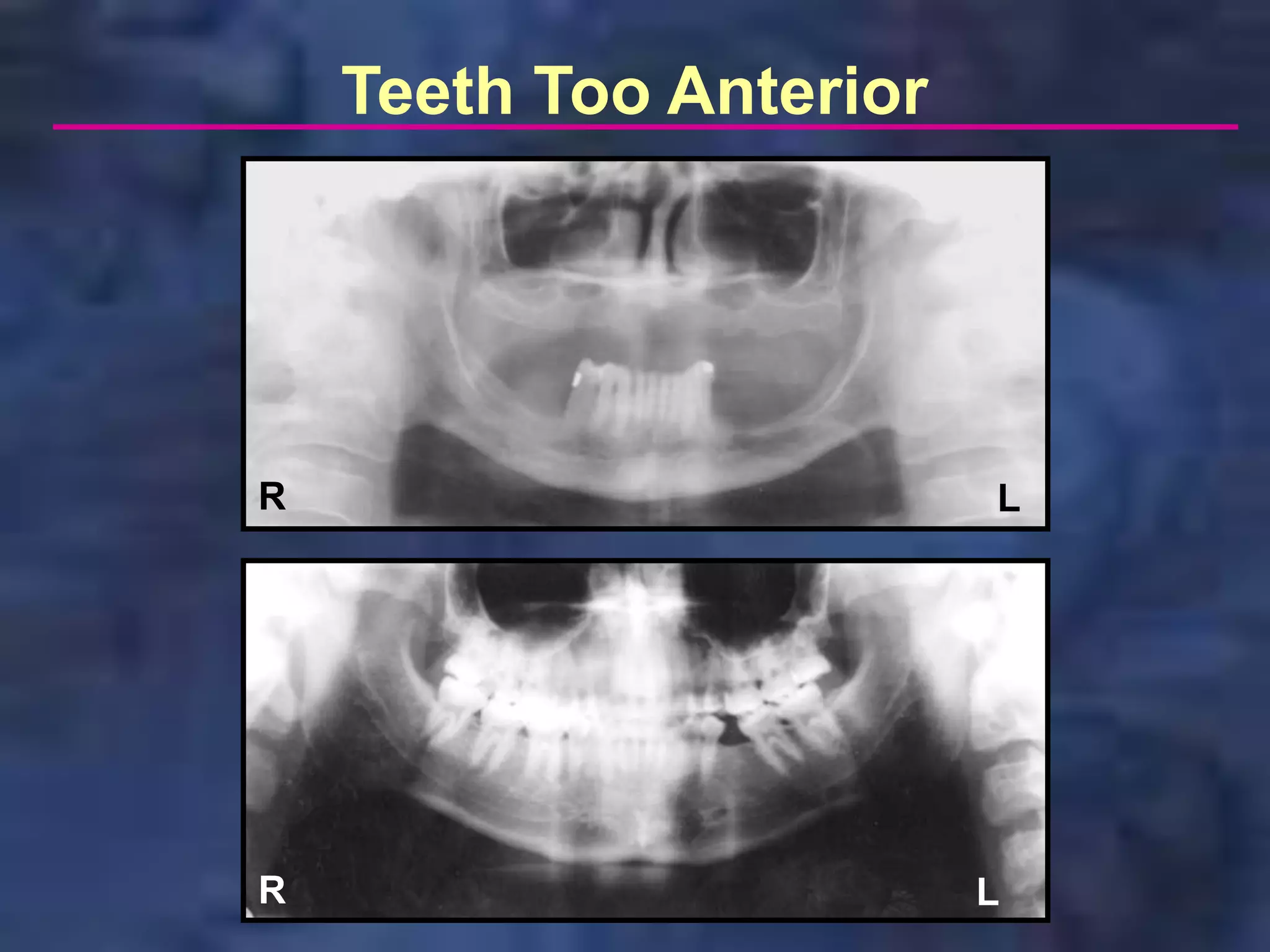 Teeth Too Anterior




R                        L




R                        L
 