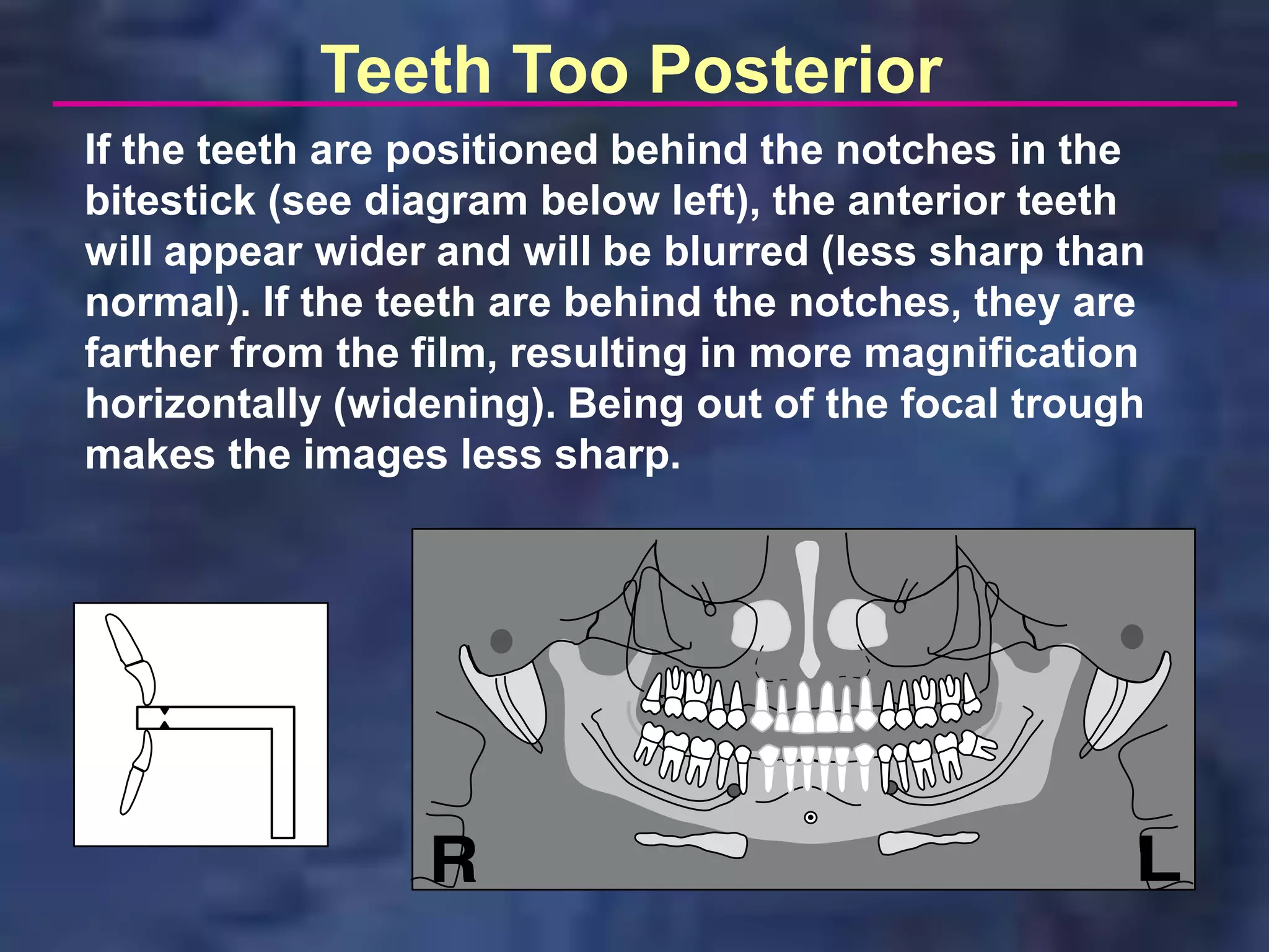 Teeth Too Posterior
If the teeth are positioned behind the notches in the
bitestick (see diagram below left), the anterior teeth
will appear wider and will be blurred (less sharp than
normal). If the teeth are behind the notches, they are
farther from the film, resulting in more magnification
horizontally (widening). Being out of the focal trough
makes the images less sharp.
 