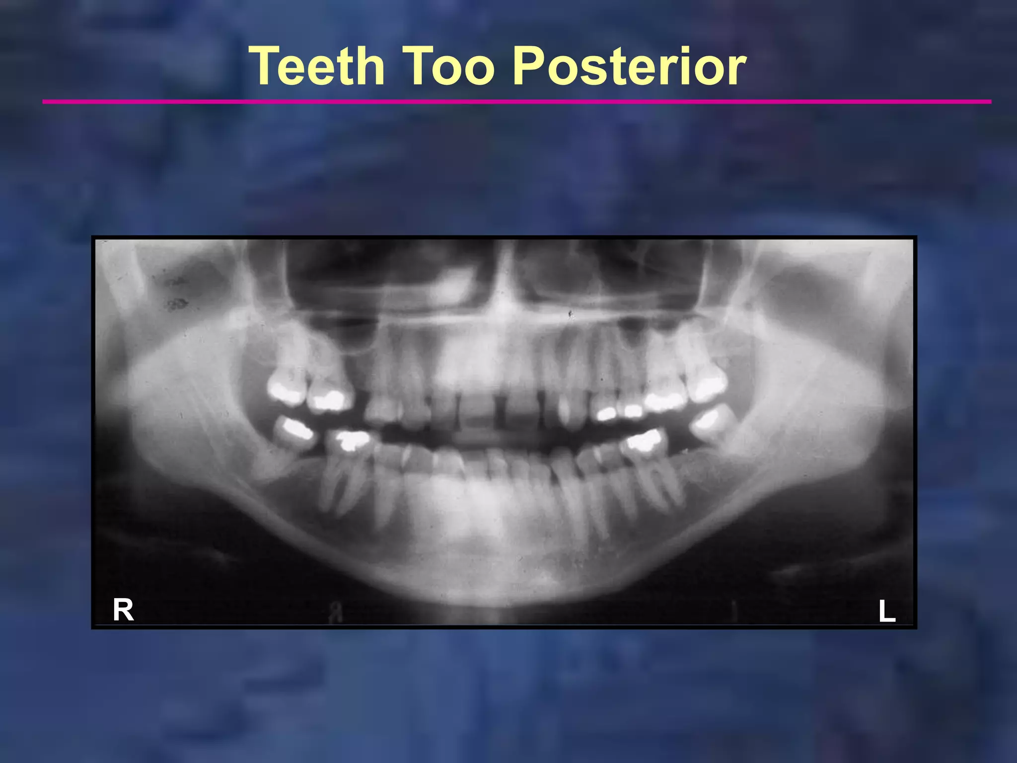Teeth Too Posterior




R                         L
 
