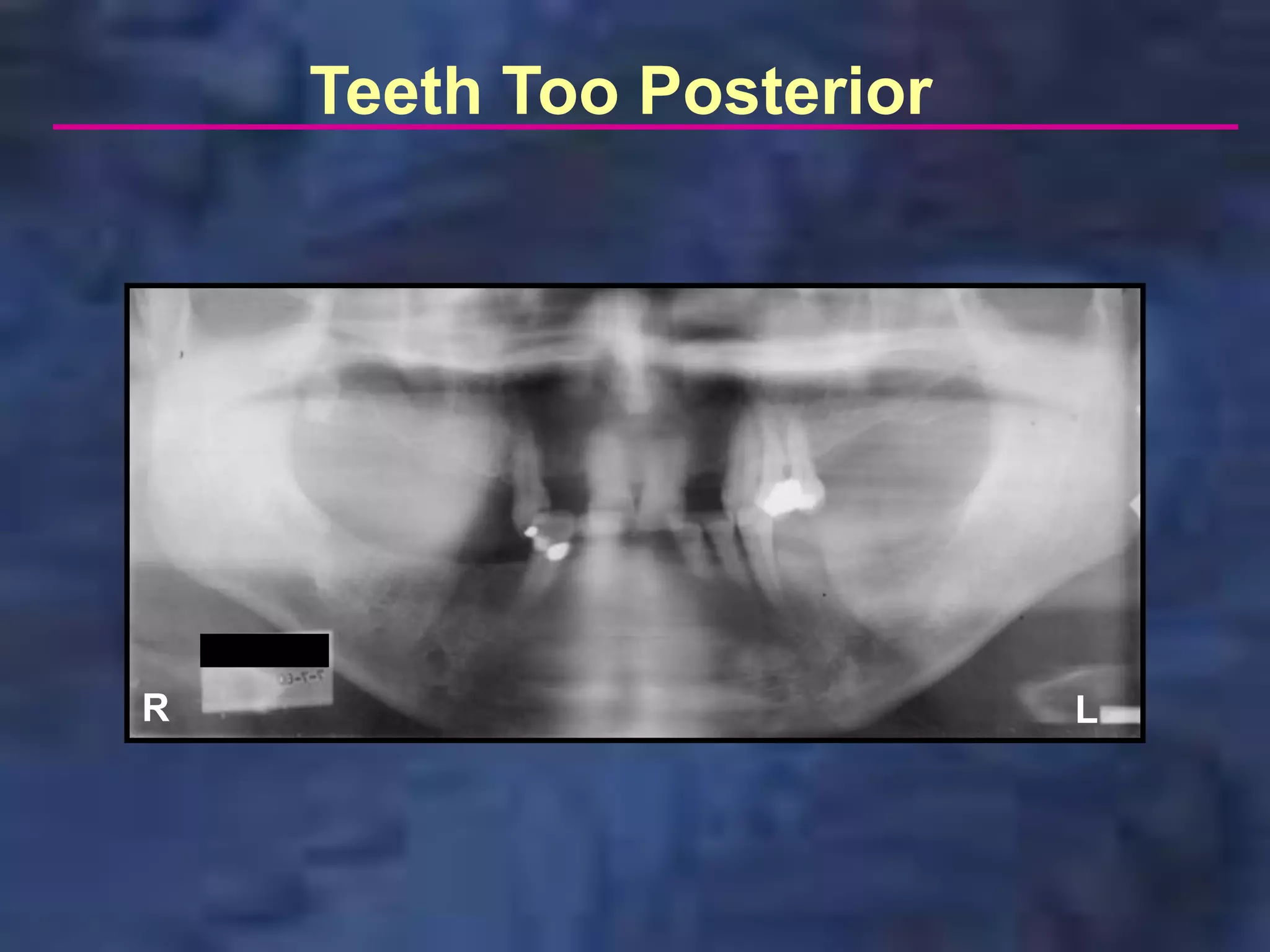 Teeth Too Posterior




R                         L
 