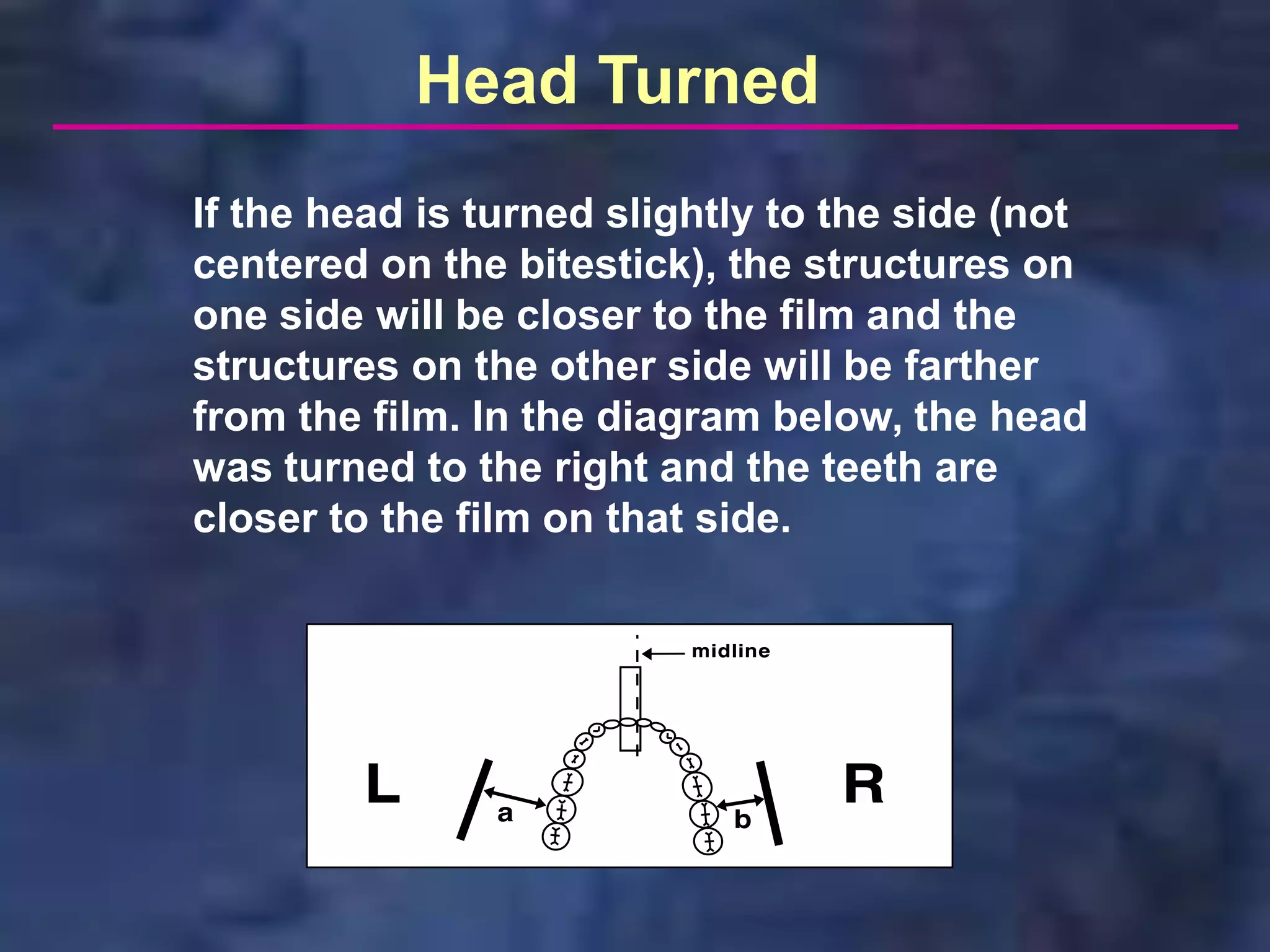 Head Turned
If the head is turned slightly to the side (not
centered on the bitestick), the structures on
one side will be closer to the film and the
structures on the other side will be farther
from the film. In the diagram below, the head
was turned to the right and the teeth are
closer to the film on that side.
 