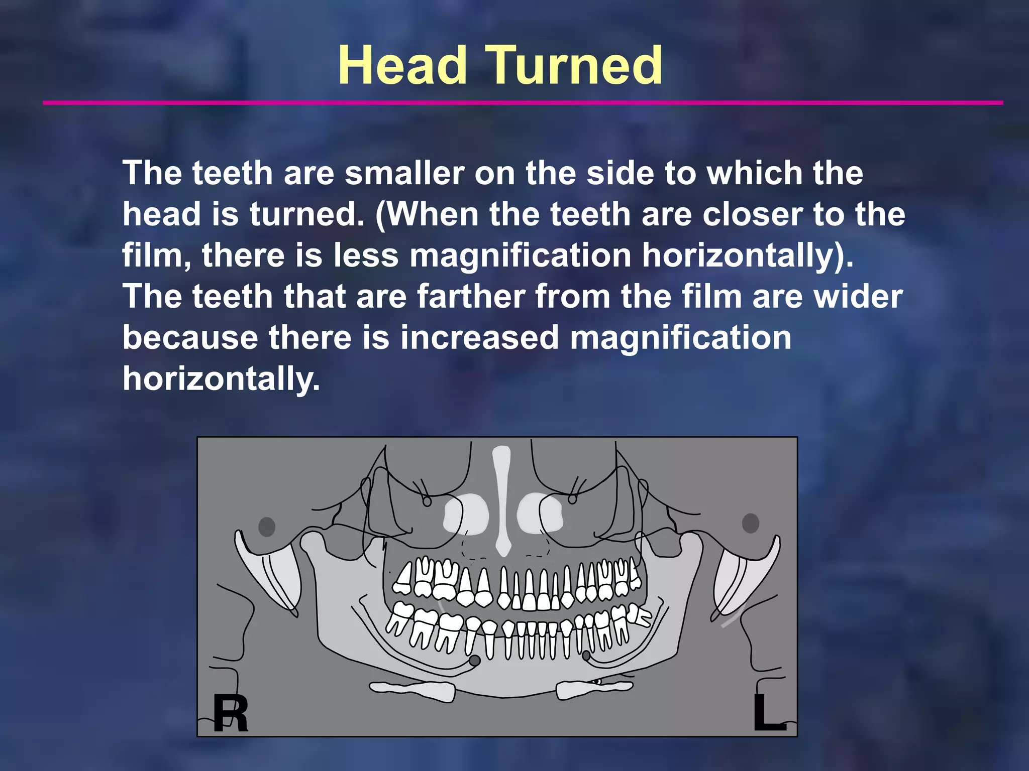 Head Turned
The teeth are smaller on the side to which the
head is turned. (When the teeth are closer to the
film, there is less magnification horizontally).
The teeth that are farther from the film are wider
because there is increased magnification
horizontally.
 