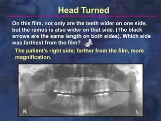 Head Turned
On this film, not only are the teeth wider on one side,
but the ramus is also wider on that side. (The black
arrows are the same length on both sides). Which side
was farthest from the film?
 The patient’s right side; farther from the film, more
 magnification.




    R                                            L
 