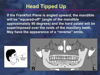 Head Tipped Up
If the Frankfort Plane is angled upward, the mandible
will be “squared-off” (angle of the mandible
approximately 90 degrees) and the hard palate will be
superimposed over the roots of the maxillary teeth.
May have the appearance of a “reverse” smile.
 