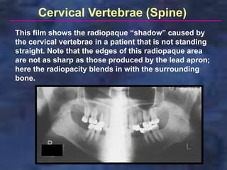Cervical Vertebrae (Spine)
This film shows the radiopaque “shadow” caused by
the cervical vertebrae in a patient that is not standing
straight. Note that the edges of this radiopaque area
are not as sharp as those produced by the lead apron;
here the radiopacity blends in with the surrounding
bone.
 