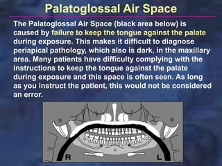 Palatoglossal Air Space
The Palatoglossal Air Space (black area below) is
caused by failure to keep the tongue against the palate
during exposure. This makes it difficult to diagnose
periapical pathology, which also is dark, in the maxillary
area. Many patients have difficulty complying with the
instructions to keep the tongue against the palate
during exposure and this space is often seen. As long
as you instruct the patient, this would not be considered
an error.
 