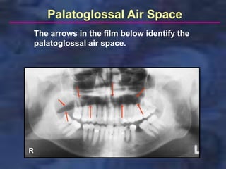 Palatoglossal Air Space
    The arrows in the film below identify the
    palatoglossal air space.




R
 