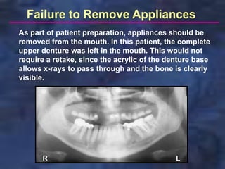 Failure to Remove Appliances
As part of patient preparation, appliances should be
removed from the mouth. In this patient, the complete
upper denture was left in the mouth. This would not
require a retake, since the acrylic of the denture base
allows x-rays to pass through and the bone is clearly
visible.




      R                                      L
 