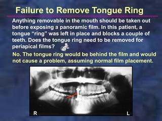 Failure to Remove Tongue Ring
Anything removable in the mouth should be taken out
before exposing a panoramic film. In this patient, a
tongue “ring” was left in place and blocks a couple of
teeth. Does the tongue ring need to be removed for
periapical films?
No. The tongue ring would be behind the film and would
not cause a problem, assuming normal film placement.




       R                                  L
 