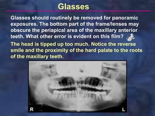 Glasses
Glasses should routinely be removed for panoramic
exposures. The bottom part of the frame/lenses may
obscure the periapical area of the maxillary anterior
teeth. What other error is evident on this film?
The head is tipped up too much. Notice the reverse
smile and the proximity of the hard palate to the roots
of the maxillary teeth.




        R                                     L
 