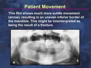 Patient Movement
This film shows much more subtle movement
(arrow), resulting in an uneven inferior border of
the mandible. This might be misinterpreted as
being the result of a fracture.




   R
 