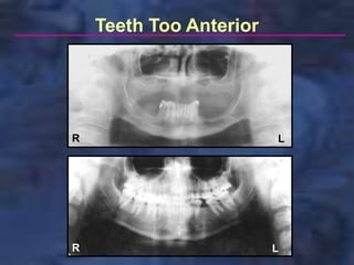 Teeth Too Anterior




R                        L




R                        L
 