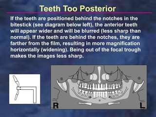 Teeth Too Posterior
If the teeth are positioned behind the notches in the
bitestick (see diagram below left), the anterior teeth
will appear wider and will be blurred (less sharp than
normal). If the teeth are behind the notches, they are
farther from the film, resulting in more magnification
horizontally (widening). Being out of the focal trough
makes the images less sharp.
 