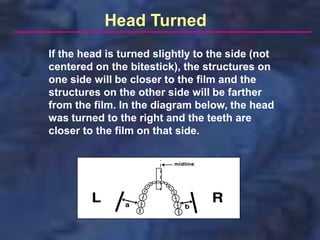 Head Turned
If the head is turned slightly to the side (not
centered on the bitestick), the structures on
one side will be closer to the film and the
structures on the other side will be farther
from the film. In the diagram below, the head
was turned to the right and the teeth are
closer to the film on that side.
 