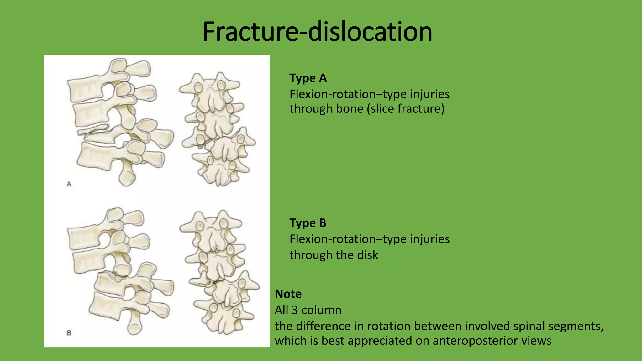 319 thoracolumbar trauma | PPTX