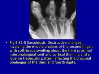 31 dactylitis | PPTX