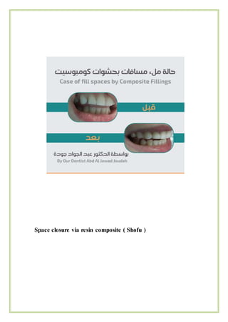 Space closure via resin composite ( Shofu )
 