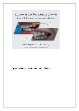 Space closure via resin composite ( Shofu )
 