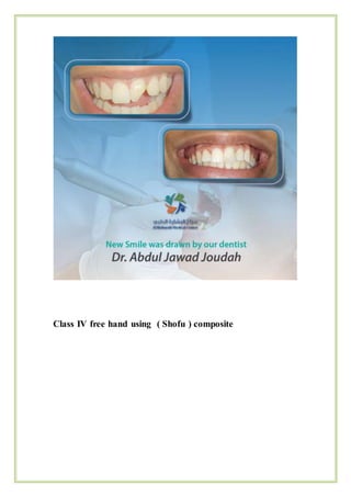 S
Class IV free hand using ( Shofu ) composite
 