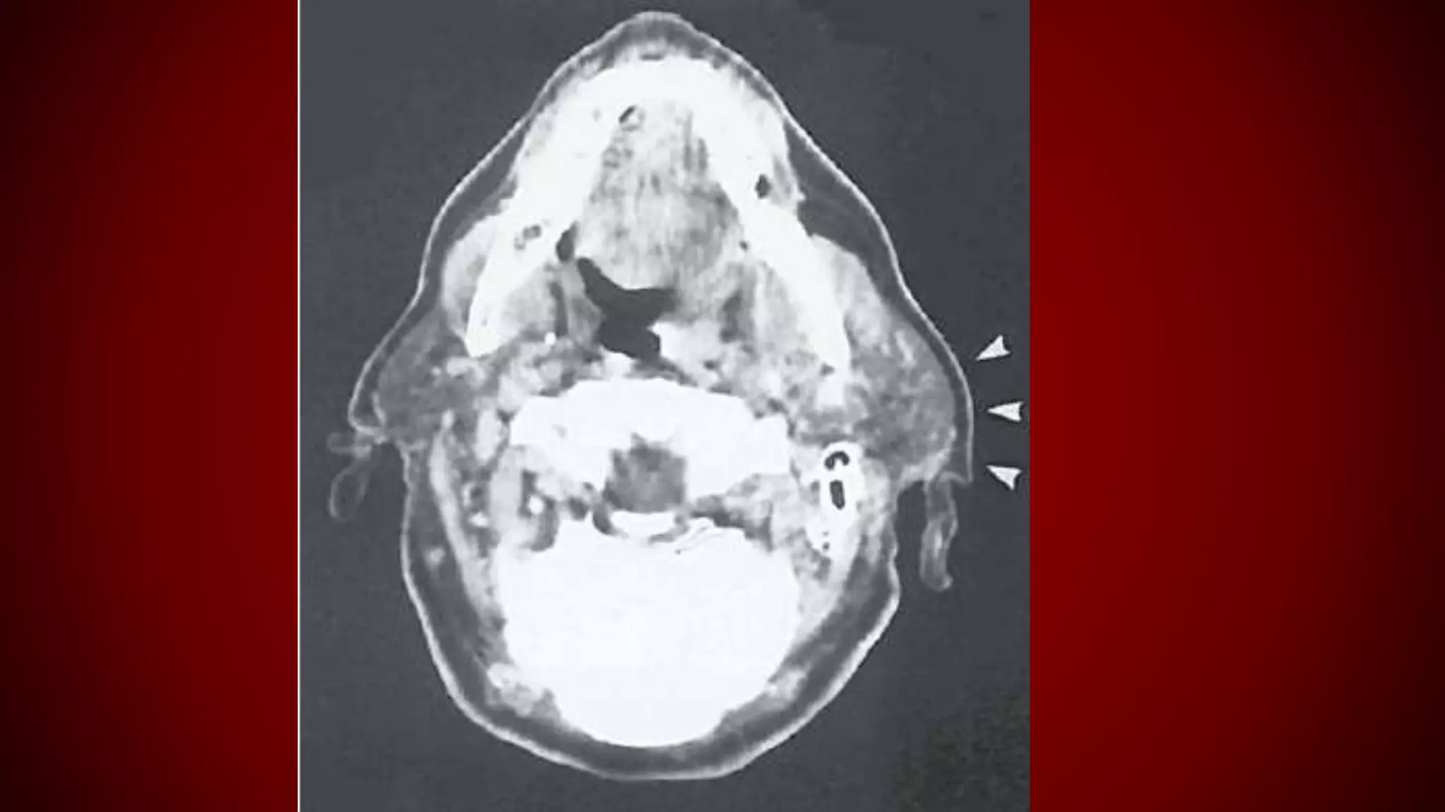 radiographic-features-of-normal-and-abnormal-salivary-glands-pptx
