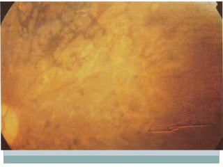 perdida crónica de la visión