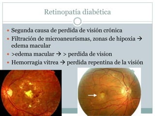 Retinopatía diabética

 Segunda causa de perdida de visión crónica
 Filtración de microaneurismas, zonas de hipoxia 
  edema macular
 >edema macular  > perdida de vision
 Hemorragia vitrea  perdida repentina de la visión
 
