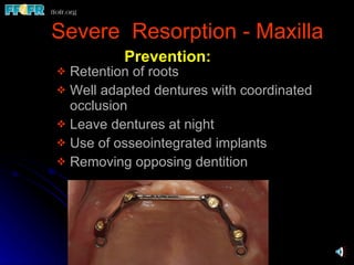 32.preprosthetic surgical procedures (n) | PPT | Dental Health ...