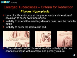 32.preprosthetic surgical procedures (n) | PPT
