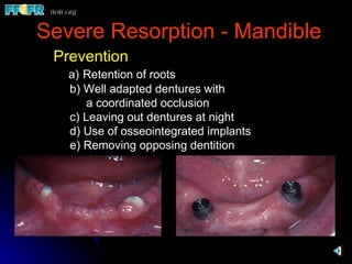 32.preprosthetic surgical procedures (n) | PPT | Dental Health ...