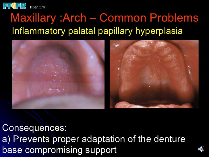32.preprosthetic surgical procedures (n)