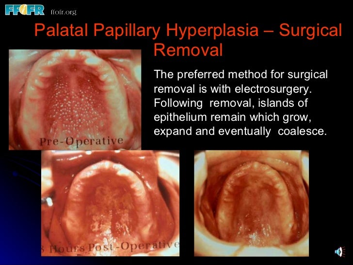 32.preprosthetic surgical procedures (n)