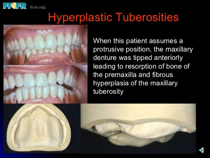 32.preprosthetic surgical procedures (n)