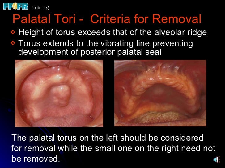 32.preprosthetic surgical procedures (n)
