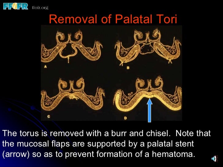 32.preprosthetic surgical procedures (n)
