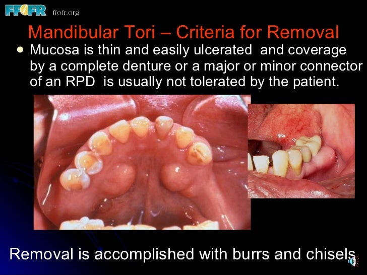 32.preprosthetic surgical procedures (n)