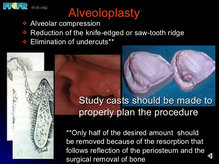 32.preprosthetic surgical procedures (n)