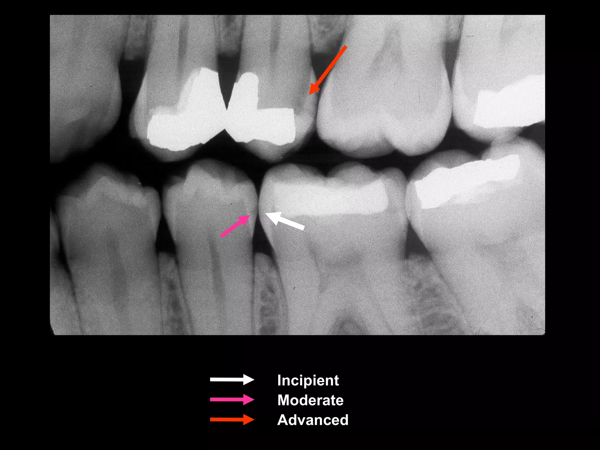Radiographic caries diagnosis PDF