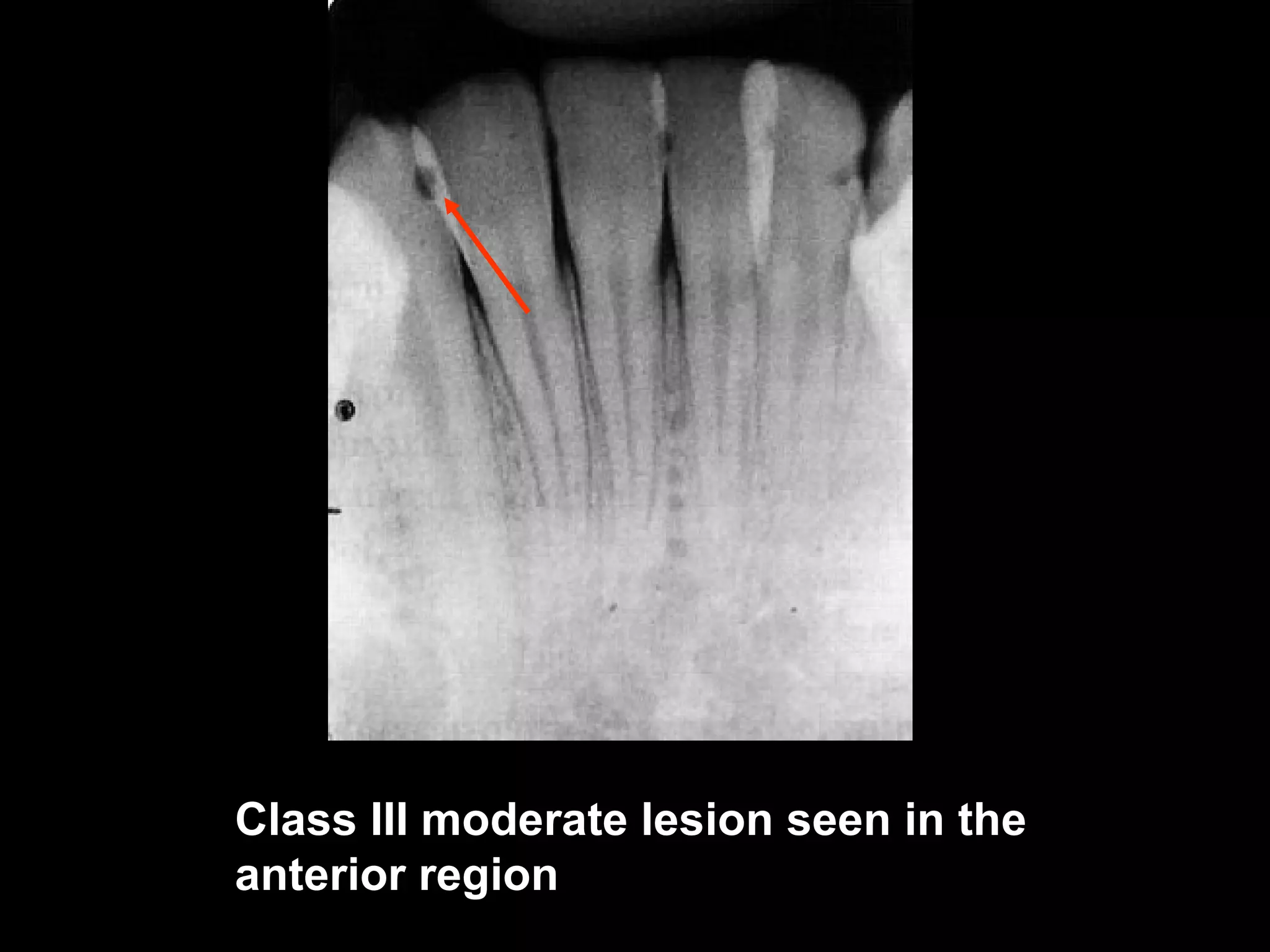 radiographic-caries-diagnosis | PDF