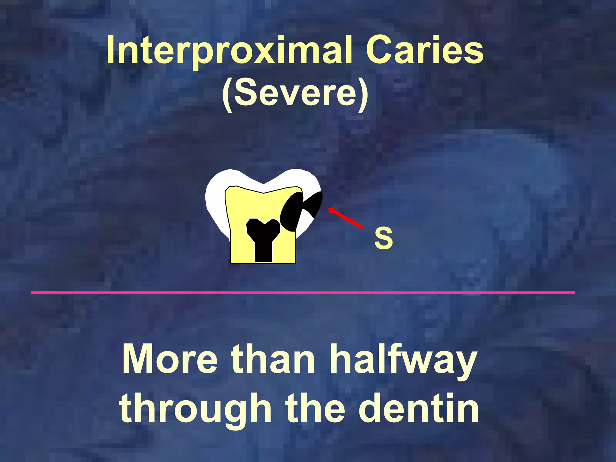 radiographic-caries-diagnosis | PDF